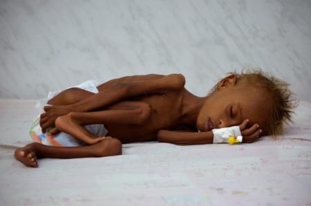 وكالات دولية: أكثر من مليون طفل يمني يعانون الجوع